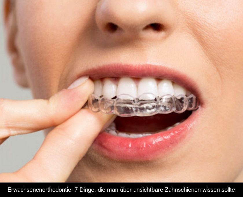 Erwachsenenorthodontie: 7 Dinge, Die Man über Unsichtbare Zahnschienen Wissen Sollte