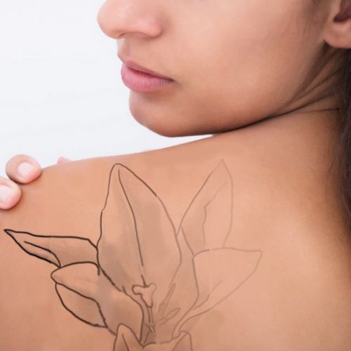 Ästhetische Medizin: Ein Tattoo mit Laser entfernen lassen in 5 Fragen