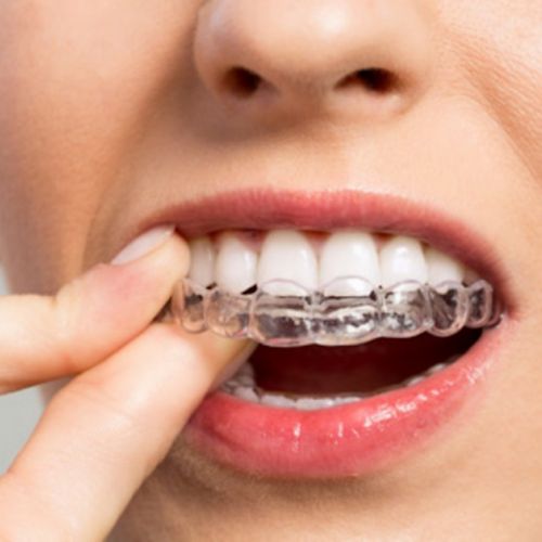 Erwachsenenorthodontie: 7 Dinge, die man über unsichtbare Zahnschienen wissen sollte
